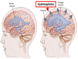  Congenital & Infectious Hydrocephalus