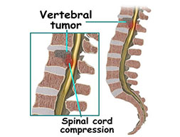  Spinal Cord Tumors
