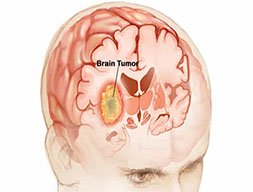 Brain Tumors