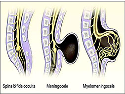 Meningomyelocele