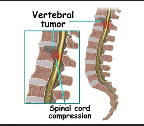  Spinal Cord Tumors