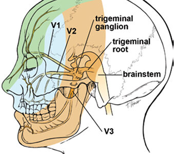 Trigeminal-neuralgia